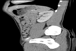 Eine MRT-Aufnahme eines Knies mit einem Bruch in der Mitte, umgeben von einem dunklen Hintergrund.