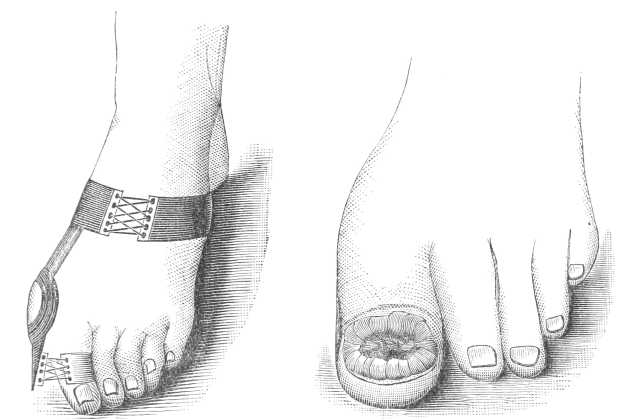 Schwarze und weiße Zeichnung von zwei Füßen, einer mit einem Verband und der andere mit einer sichtbaren Fraktur, mit Text unten, der die medizinische Behandlung angibt.